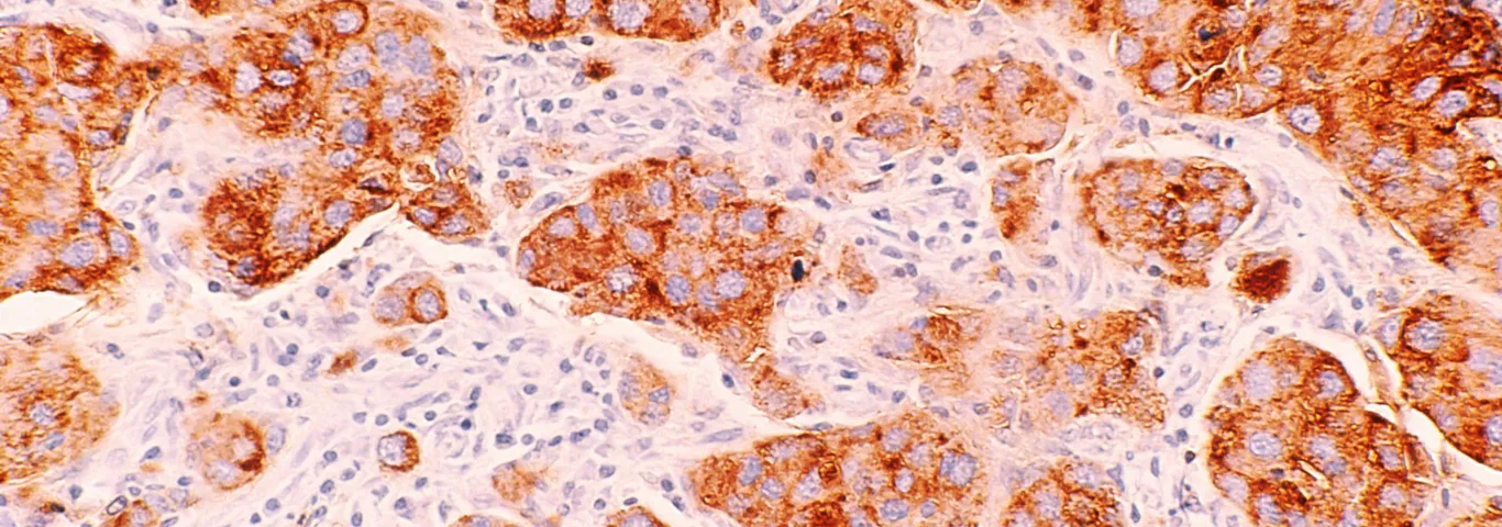 Breast cancer cells stained red againt a light-pink, speckled background